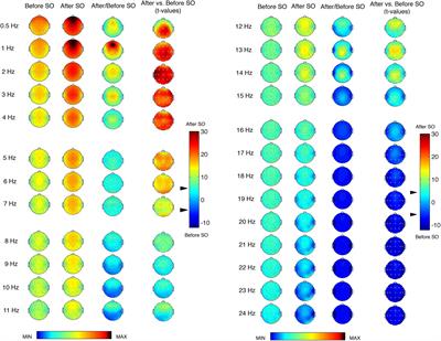 The Spatiotemporal Pattern of the Human Electroencephalogram at Sleep Onset After a Period of Prolonged Wakefulness